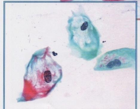 dysplastic One, two or three nuclei (commonly