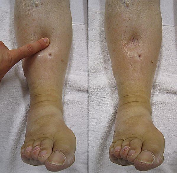 Pedal edema during and after the