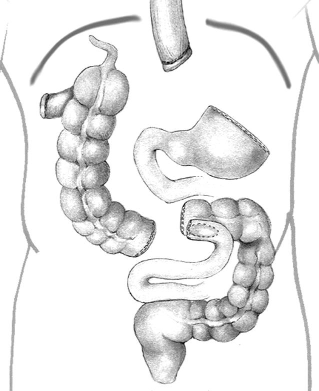 Thoracic Phase of Minimally Invasive Ivor Lewis Esophagogastrectomy With Colonic Interposition The patient was then repositioned in a left lateral decubitus position.