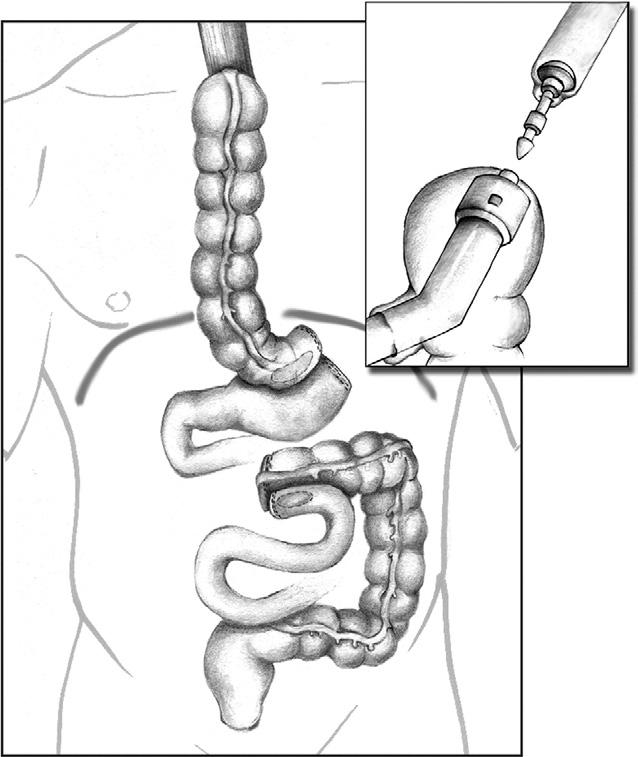 Inset represents construction of the esophagocolic anastomosis using a circular stapler. involvement to 3 cm above the gastroesophageal junction.