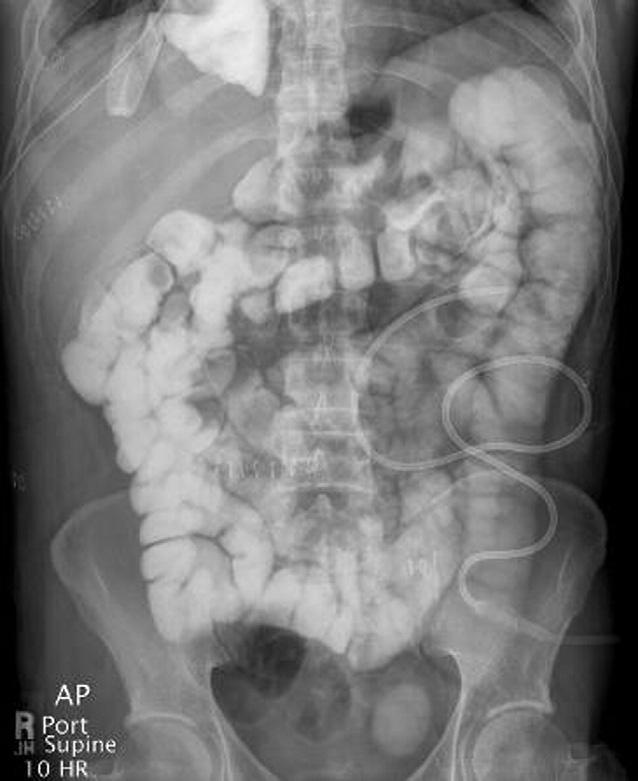Sixteen of 18 lymph nodes had cancer involvement. Fig 7. Postoperative abdominal x-ray film showing the descending colon on the left with the entire small bowel on the right side of the abdomen.