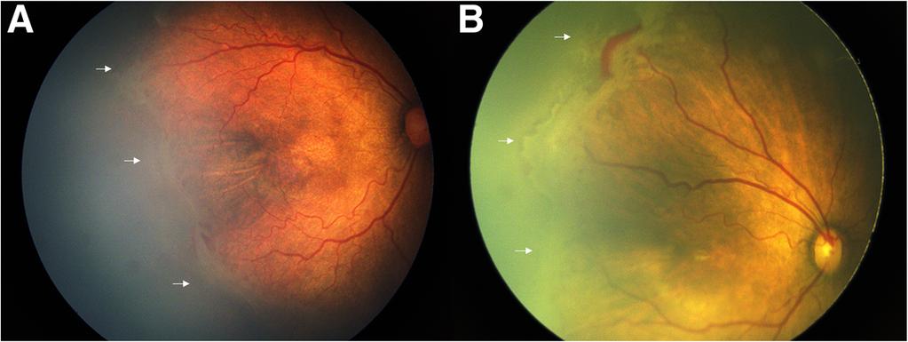 Lyu et al. BMC Ophthalmology (2019) 19:60 the initial ridge to the more anterior ridge. Additionally, eleven (41%) eyes exhibited hemorrhage on ridge or in the vitreous cavity (Fig.