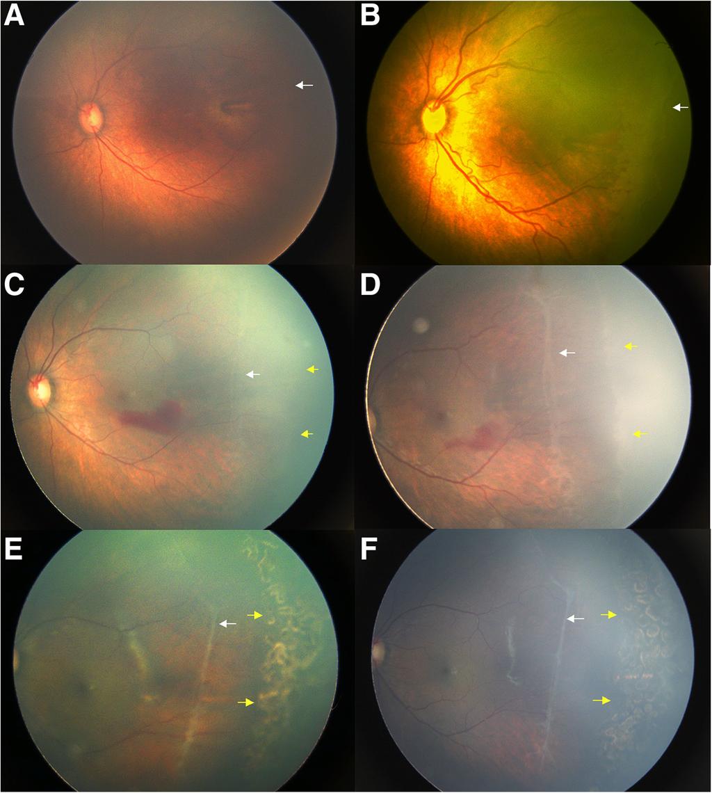 Lyu et al. BMC Ophthalmology (2019) 19:60 Page 6 of 7 Fig. 2 Fundus images of an infant with Type 1 ROP who received primary IVR treatment.