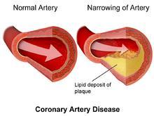 Week 3: Cardiovascular Disease Learning Outcomes: 1. Define the difference forms of CVD 2. Describe the various risk factors of CVD 3. Describe atherosclerosis and its stages 4.