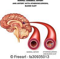 Stroke: Clinical manifestation of cerealvascular disease. Two types: 1.