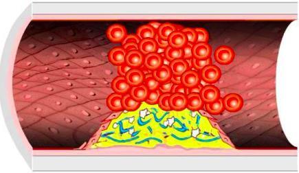 LO4. Describe the Role of Oxidation, Inflammation, Cholesterol and Lipoproteins in CVD Atherosclerosis begins when there is damage to the endothelial cells.