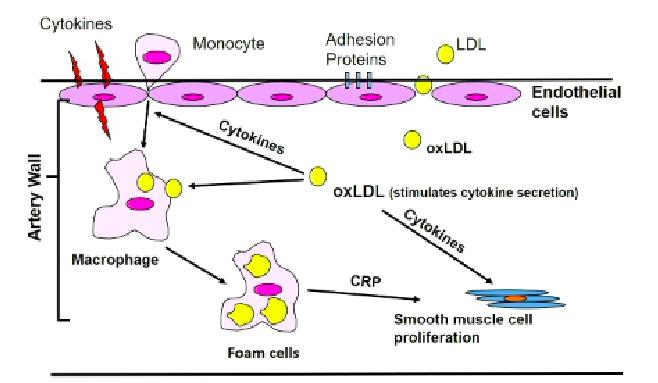 Endothelial Dysfunction: once there is damage to the endothelial cells (as above), LDL cholesterol is attracted to the site of injury! The LDL molecules then become oxidised.