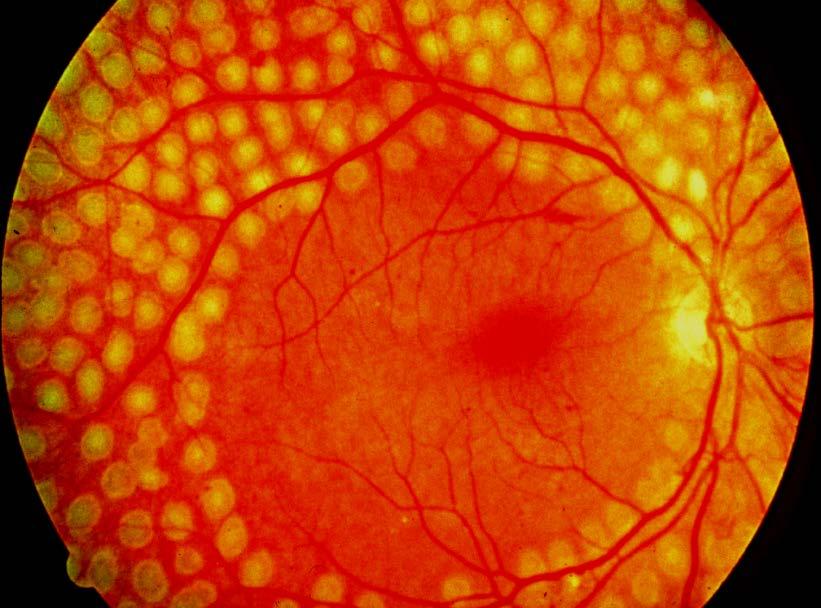 Panretinal Laser Photocoagulation Benefits: Suppression of severe visual loss 50% reduction in all patients 96% reduction in patients approaching high-risk