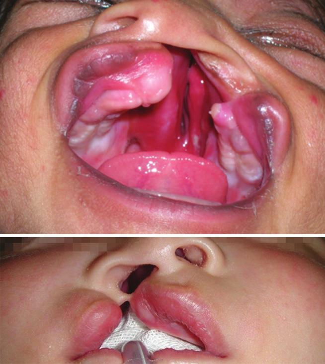 Received: 14 th August 2015 Accepted: 19 th November 2015 Conflicts of Interest: None Source of Support: Nil Original Research Simonart s Bands and Facial Growth in Unilateral Cleft Lip and Palate