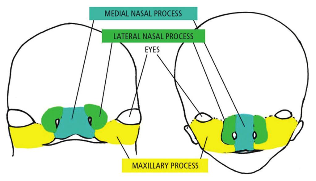 and medial nasal processes or defective cell death programing in epithelial surfaces (Figure 2). These bands could result from post fusion rupture of tissues as explained by Goss.