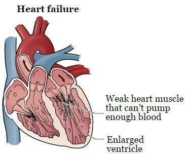Figure 1. Normal heart Figure 2.