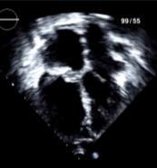 risk of paradoxical embolism* Rare isolated PFO