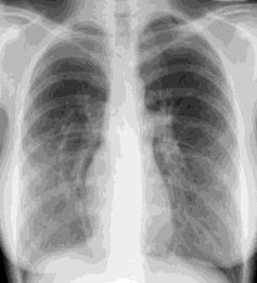 Anomalous right upper pulmonary vein Remember sub-costal imaging!