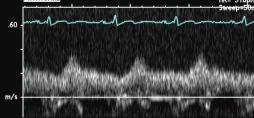 Abdominal Aorta PW Doppler This abdominal aorta PW Doppler profile is seen with which of the following? 1.