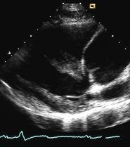 Aortic dissection 2018 MFMER 3727943-175 2018 MFMER 3727943-176 21-Year-Old Male with Hypertension