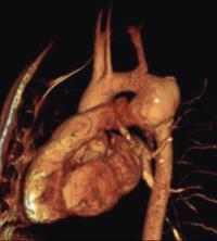 Anastomotic aneurysms have been found >30 years after