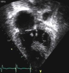 Descending aorta and left pulmonary artery 2018 MFMER 3727943-235 2018 MFMER