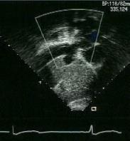 Fontan Lateral Right Atrial