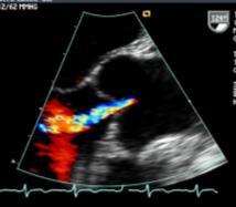 Unicuspid aortic valve 2.