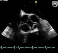 Tricuspid aortic valve 4.