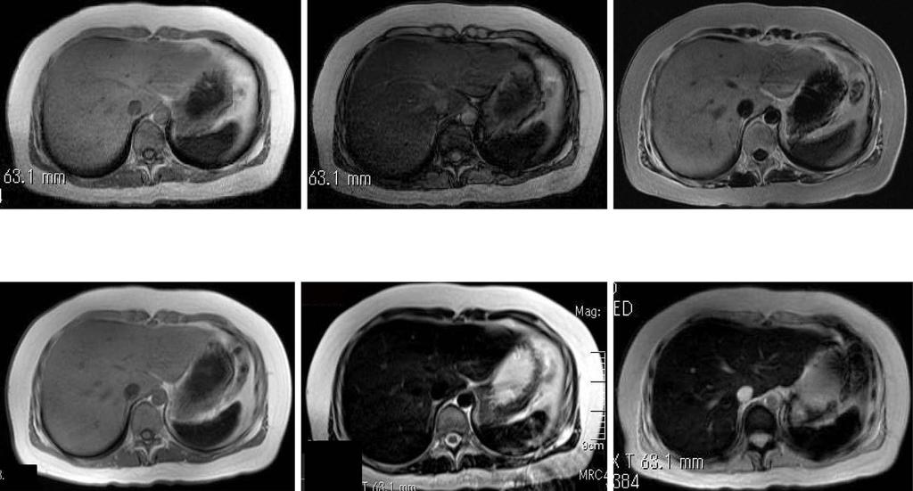 Figure 2. Axial T1-weighted fat-suppressed GRE pulse sequences during abdominal MRI, showing high signals on in-phase images and low signals on opposed-phase images.