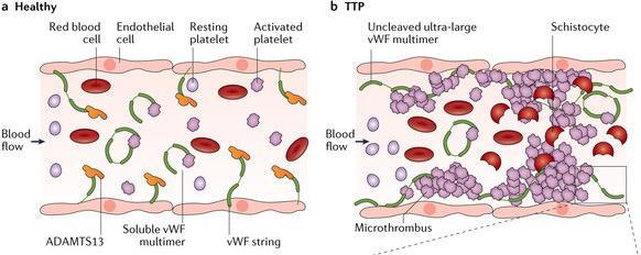 TTP pathophysiology Caused by ADAMTS13 deficiency (A Disintegrin And Metalloproteinase with ThromboSpondin type 1 motifs, member 13) ADAMTS13 cleaves the VWF subunit at the Tyr1605 Met1606 peptide
