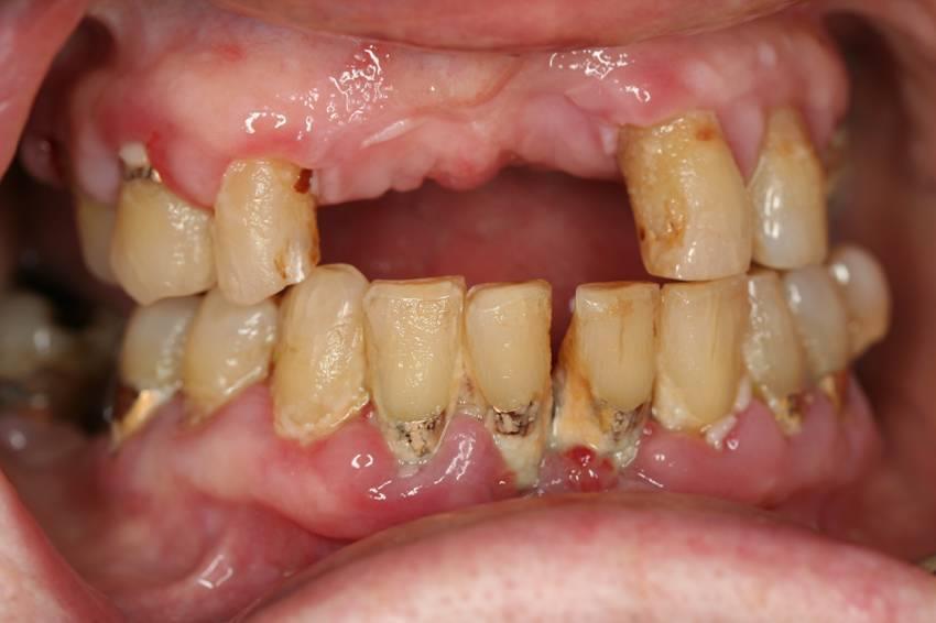 Periodontal (Gum) Disease Moderate/severe periodontitis 35-54 years old - 24.5% 55-74 years old 43.6% >75 years old 60.8% Gingival inflammation 35-54 years old 19.3% 55-74 years old 21.