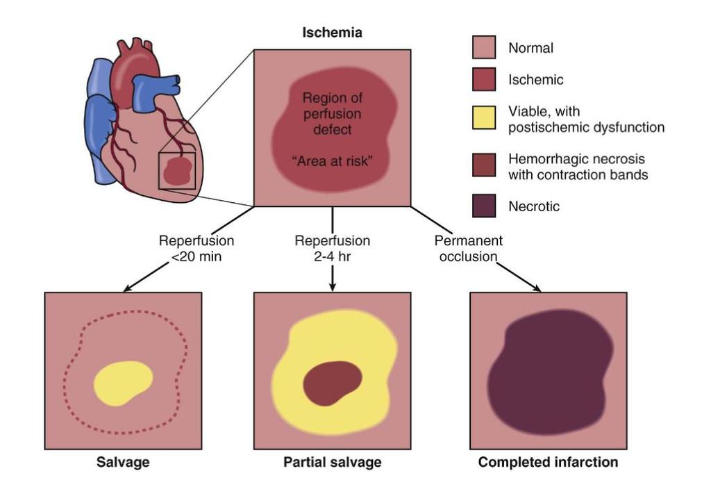Consequences of the reperfusion at various time after coronary