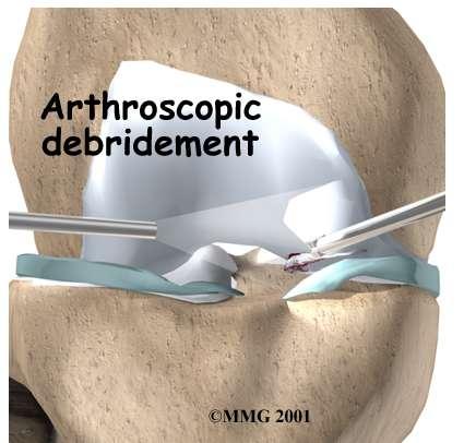 Mechanical Repair Unstable cartilage at defect is removed with arthroscopic debridement and lavage Usually