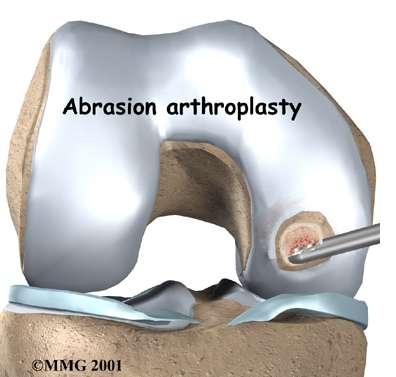 Abrasion Arthroplasty Exposed surface bone is excised by burr or shaver to a depth of 1-3 mm beneath cartilage defect