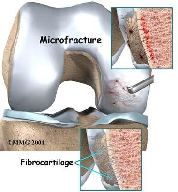 Microfracture Unstable cartilage debrided Stable edge of viable cartilage formed Helps hold the marrow clot Calcified cartilage layer removed by curette Angled awl used to create 2-4 mm deep pits