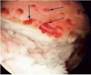 Microfracture Exposed bone is debrided of all remaining unstable cartilage Stable perpendicular edge of viable cartilage is formed around the defect Helps hold the marrow clot Calcified cartilage