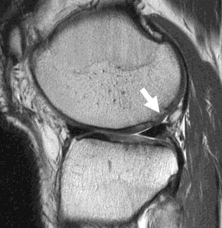 Microfracture MR features Appearance of lesion evolves over time Early postoperative period Thin and indistinct 1-2 yrs after surgery Filled defect Smooth and well-defined Bone overgrowth in 25-49%