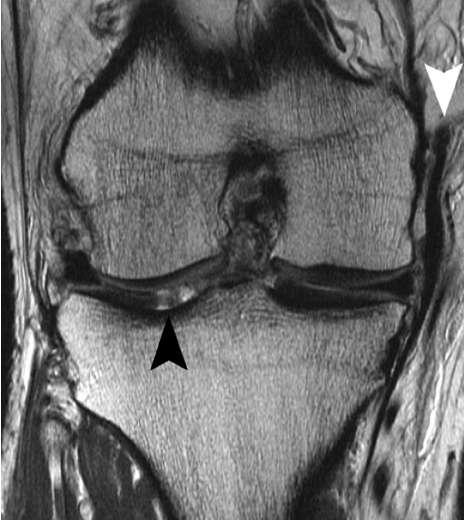 Chondral Injuries Very common Present in 63-66% patients undergoing arthroscopy 11-19% full-thickness lesions Up to