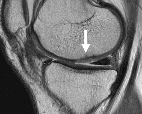 Microfracture 6 months after surgery 6 months after surgery Sagittal and coronal intermediate-weighted fast SE images acquired 6 months after a microfracture procedure in a
