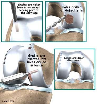 Osteochondral Autograft Transplantation OAT Transfer of osteochondral plug from non-weight bearing region of knee to site of chondral damage Most common harvest site Lateral femoral condyle