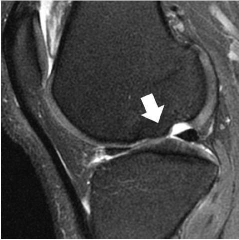 Cartilage Trauma and Degeneration Does not heal spontaneously relative avascularity of articular cartilage If injury extends to subchondral bone, usually