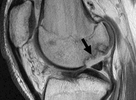 Autograft Failure 5 months after surgery Poor integration of graft with native bone Subchondral cysts with fluid signal Graft osteonecrosis Depressed subchondral bone