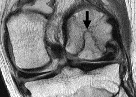 Normal edema in 50% patients during first 12 months with gradual reduction afterwards Sagittal and coronal intermediate-weighted fast SE images acquired 5 months after