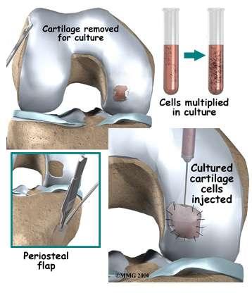 Autologous chondrocyte implantation Two-stage procedure introduced in 1994 First biopsy of normal hyaline cartilage Typically trochlea or intercondylar notch In vitro culture of chondrocytes for 6