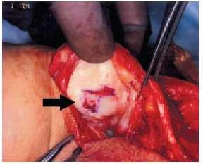 Autologous chondrocyte implantation Two-stage procedure First biopsy of normal hyaline cartilage Typically trochlea
