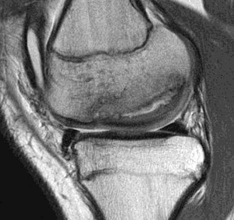 unstable osteochondritis dissecans, with a focal fissure (arrow) that extends into the