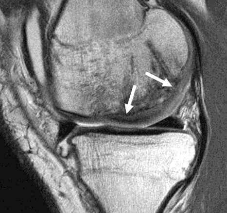 16-year-old boy show features of unstable osteochondritis