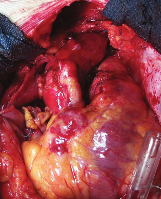 : aorta, LCA: left coronary artery, : main pulmonary artery, : right coronary artery, : right ventricle.