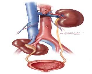 Dromedary hump agenesis Ectopic kidney horseshoe - isthmus of tissue