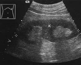 b Malrotated kidney at a slightly ectopic