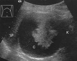 Kidney pathology finding RENAL CYSTIC DISEASE Atypical Renal Cysts Sonographic criteria: cysts may have thick walls. May contain septations.
