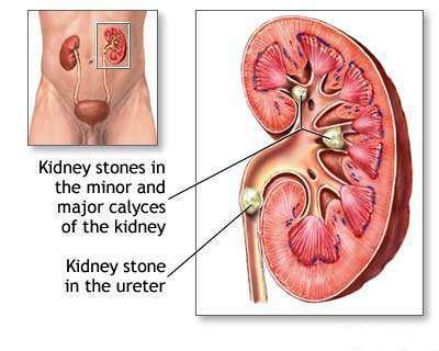 Kidney pathology finding Renal Calculus Disease Urolithiasis is most prevalent in males aged 20-40 years.1 Calculi can form in any part of the urinary tract but most form in the kidneys.
