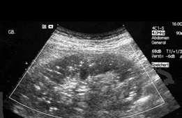 Kidney pathology finding Cortical Nephrocalcinosis Sonographic criteria: increased