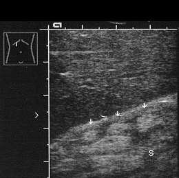 Medullary Nephrocalcinosis Sonographic criteria: The renal pyramids appear more echogenic than the adjacent renal cortex Pronounced medullary